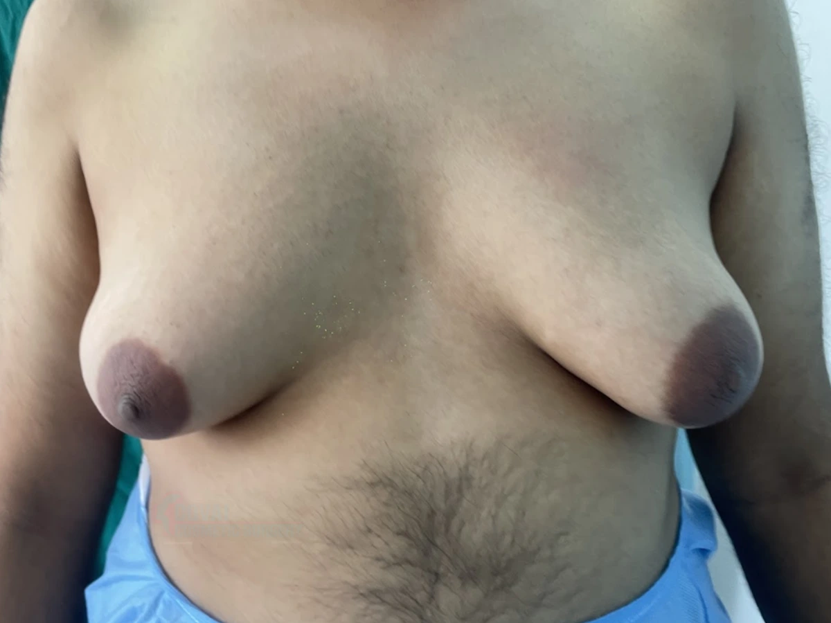 Before - Severe